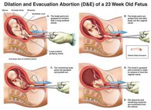 Abortion2